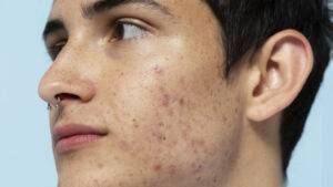 acne comprimido espinha