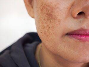 melasma; dermatologista; manchas